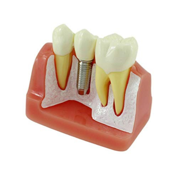 Dental Implant With Bridge Educational Model
