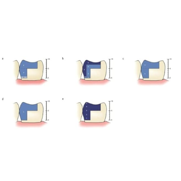 Untitled design - 2024-06-11T165954.875 Nano Bulk Fill Composite